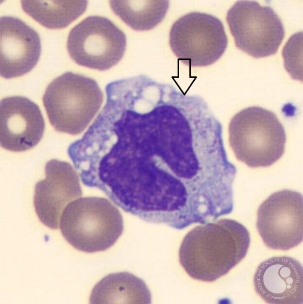 Fun Quiz: Hematology Cell Identification - The Mislabeled Specimen Fun ...
