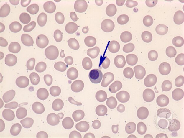 Codocyte Rbc Fun Quiz: Hematology Cell Identification - The Mislabeled Specimen Fun ...