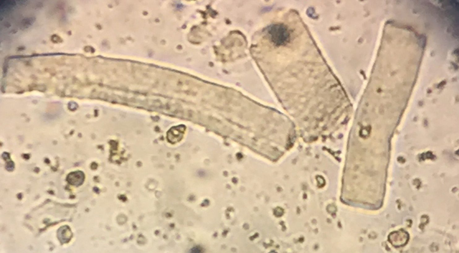 Fun Quiz Urine Sediments The Mislabeled Specimen